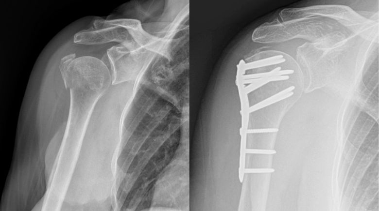 Humerus bone x ray by Orthopaedic Associates of Muskegon